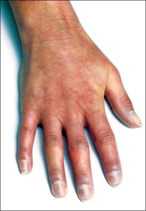 Systemic Sclerosis Advances And Prospects The Lancet