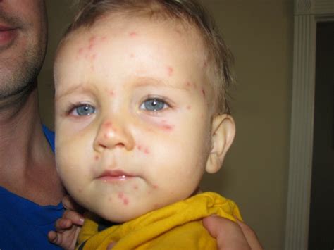 Flea Bites On Babies Face