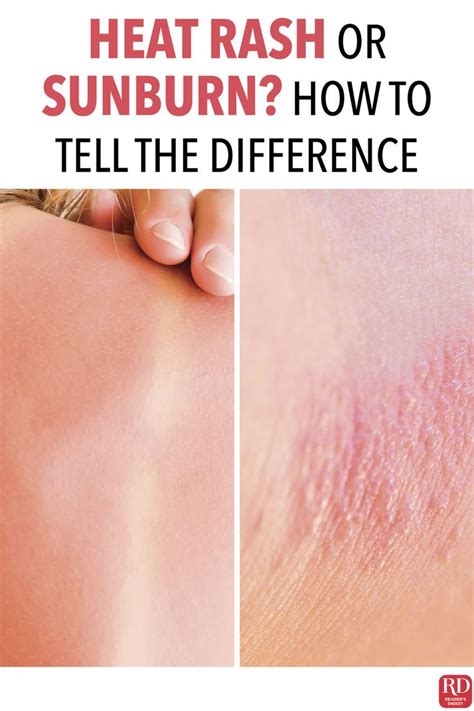 Heat Rash Or Sunburn Heres How To Tell The Difference Heat Rash