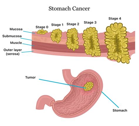 Best Stomach Cancer Doctors In Delhi Stomach Cancer Specialist In