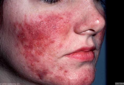 Rosacea Wat Te Doen Tegen Rosacea