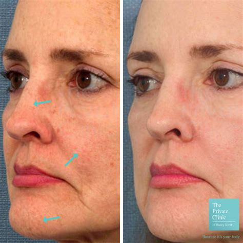 Best Non Surgical Anti Aging Treatments 2022 Top 7 Wrinkle Treatment Uk