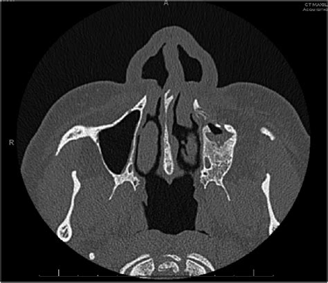 Ct Of The Sinuses Without Contrast Chronic Left Maxillary Sinusitis