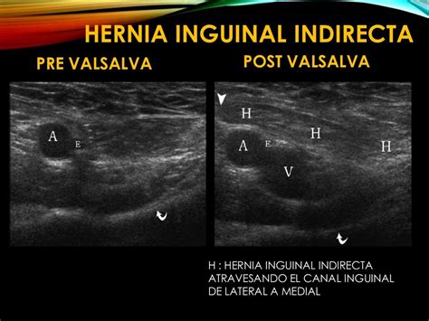 Hernia Inguinal Imagenologia