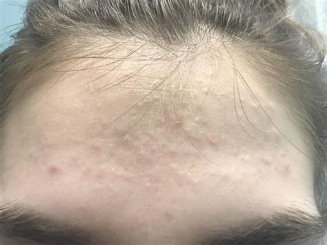 Skin Colored Bumps On Face Reddit Naturalskins