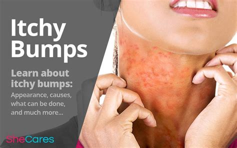 Small Red Itchy Bumps On The Skin Are A Common Presentation Of Several Different Rashes Learn