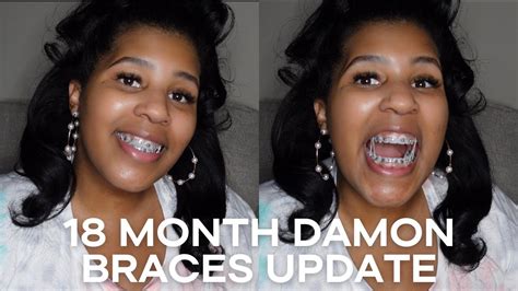 Month Update Adult Damon Braces And What To Expect Damon Braces