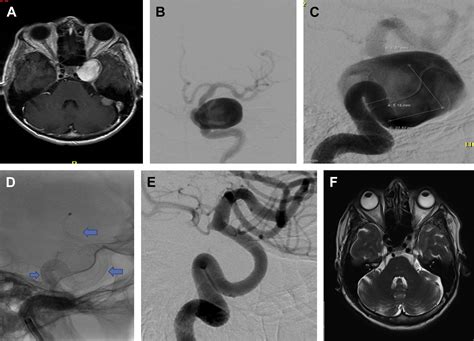 Endovascular Management Of Cavernous And Paraclinoid Aneurysms
