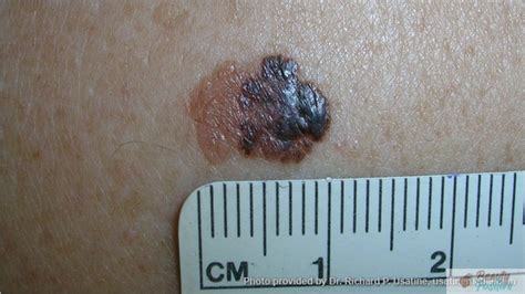 Understanding Skin Cancer Types Symptoms And Treatment