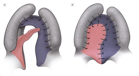 The Double Transposition Flap For Closure Of The Extremely Wide Hard