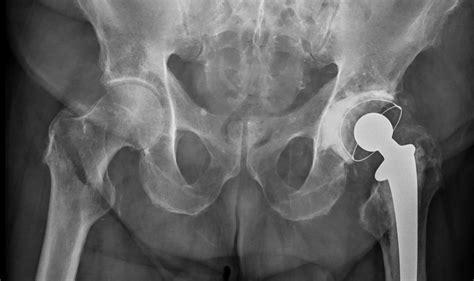 Hip Fractures May Increase Death Risk In Senior Citizens Agency Wire
