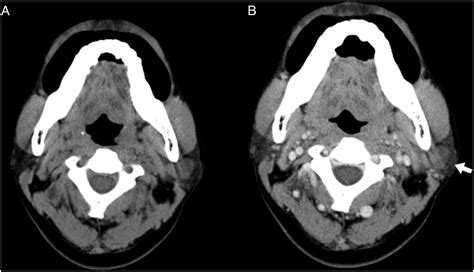 Three Cases Of Parotid Hemangiomas In Adults Yi Ting Huang Chun Yen Ou Wei Ting Lee Heng