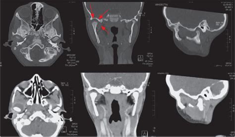 Contrast Enhanced Ct Of The Head And Neck Region Showing Arthritis With