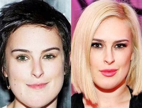 Searching For Perfection Rumer Willis Before And After Plastic Surgery In Geneve