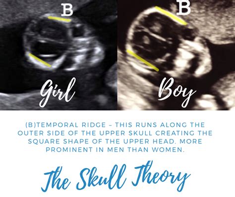 The Skull Theory The Gender Experts 12 Week Ultrasound Gender Ultrasound Gender Prediction