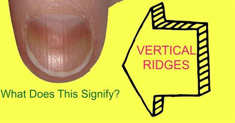 Do You Have Vertical Ridges On Your Fingernails This Could Signify