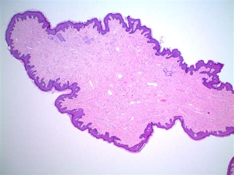 Pathology Outlines Cutaneous Fibroepithelial Polyps