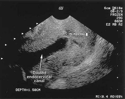 Cervical Cancer Ultrasound