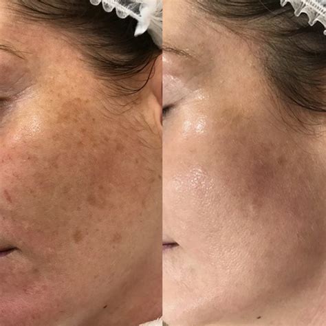 How Does Laser Remove Hyperpigmentation Justinboey