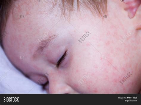 Baby Food Allergy Rash On Neck