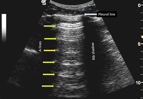 Covid 19 And The Role Of Point Of Care Ultrasound