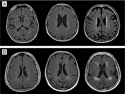 Genetics Of Age Related White Matter Lesions From Linkage To Genome