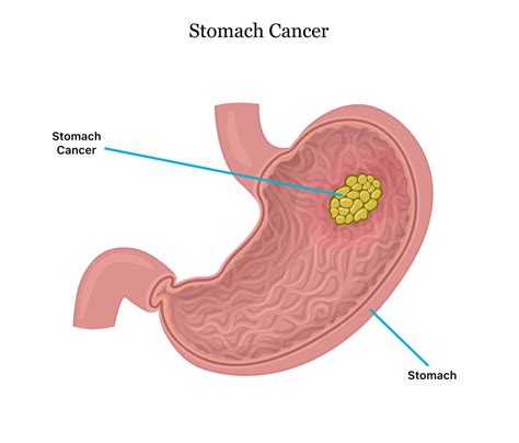Stomach Cancer Symptoms Causes Stages Treatment And Survival Rates