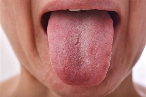 What Is Pernicious Anemia Tongue And How Is It Treated Now Then Digital