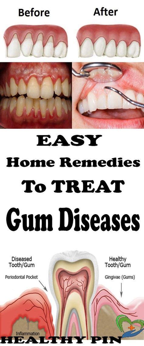 Home Remedies For Gum Disease Oralgumremedies Gum Disease