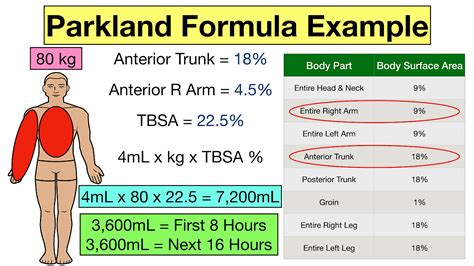 Parkland Formula For Burns Pediatric And Adult Examples Calculator