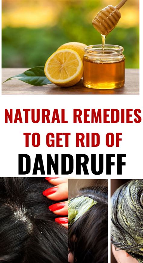 How To Get Rid Of Dandruff Naturally Permanently At Home Trabeauli