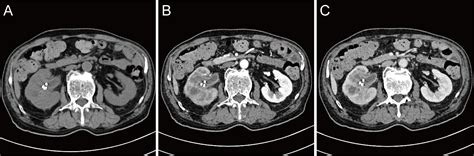 Frontiers Case Report Sarcomatoid Urothelial Carcinoma Of The Renal