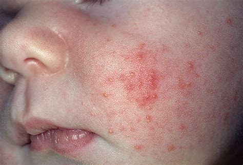 Red Bumps Heat Rash Baby Face Heat Rash On Face Pictures Baby Bumps