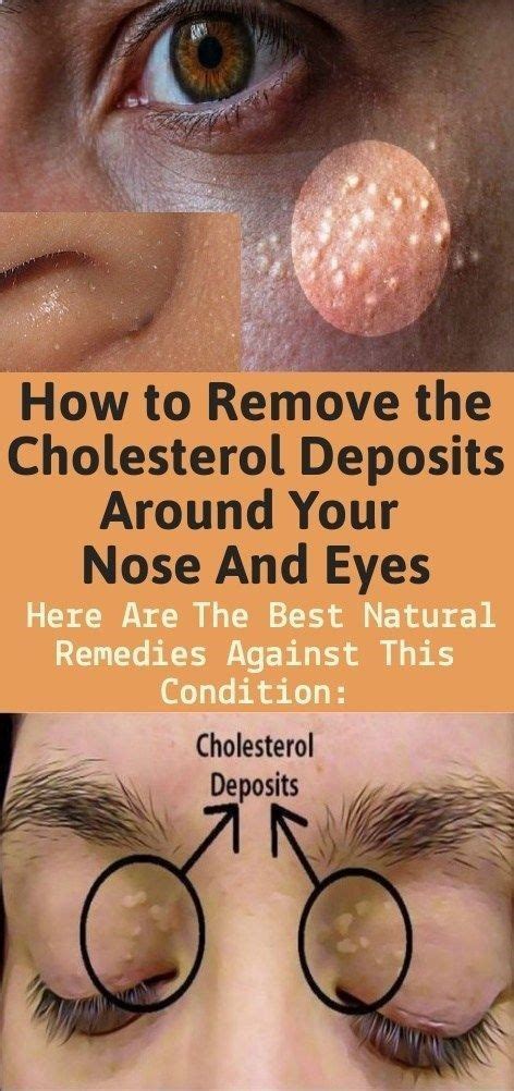 Cholesterol Deposits Around The Eyes Causes How To Remove