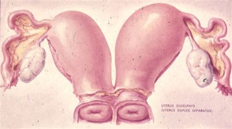The Best Illustration Of Uterine Didelphys That I Have Found Pa