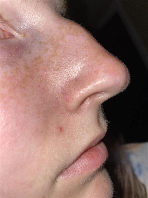 Skin Concerns Redness Is Taking Over My Face How Do I Clear It Up
