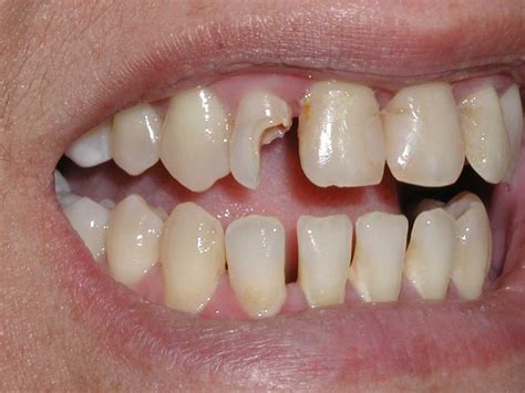 Badly Decayed Tooth Picture Dr Caputo Palm Harbor Dentist