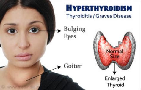 Thyroid disease in women occur 10 times more often than men. What Is Hyperthyroidism, The Symptoms And Diet To Use ...