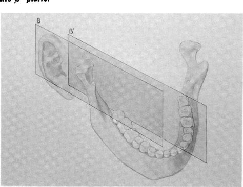 Figure 3 From The Gow Gates Technique For Mandibular Block Anesthesia