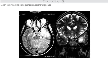 Mucormicosis rinocerebral en paciente con cefalea y diabetes mellitus. Mucormicosis rinocerebral en paciente con cefalea y ...