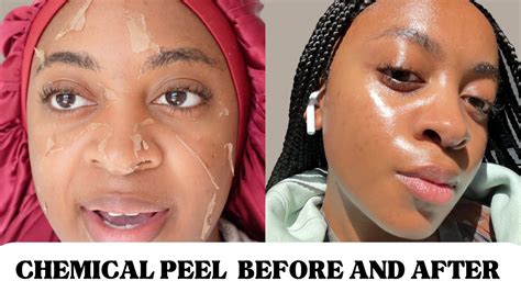Chemical Peel Full Process Before And After Hyperpigmentationacne On