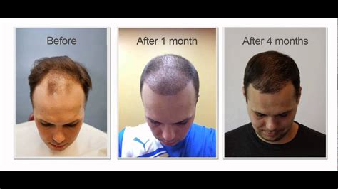 3 Month Hair Transplant Month By Month Steinerkert