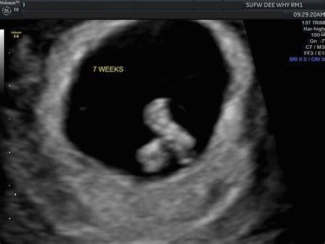 7 Week Transvaginal Ultrasound