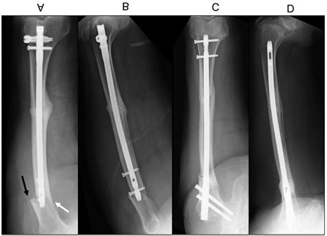 Case 1 Plain Radiographs Of The Right Femur Demonstrating The