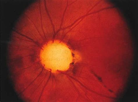 Optic Nerve Coloboma Spectrum Eyewiki
