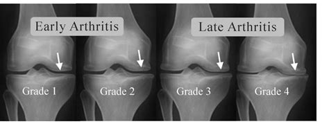 Knee Arthritis Treatment Dr Raj Kanna Knee Clinic Chennai