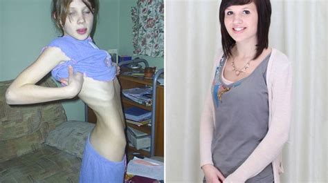 Anorexic Girl Saved By Mcdonald S Job Jo Thompson Beats Killer Disease