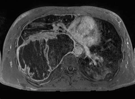 Malignant Peripheral Nerve Sheath Tumor In Nf 1 Body Mr Case Studies