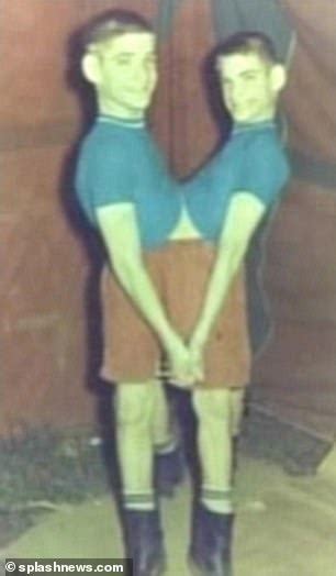 Worlds Longest Surviving Conjoined Twins Who Worked In Carnivals And