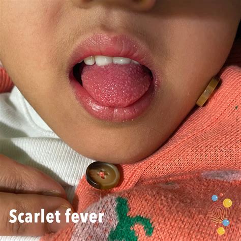 Scarlet Fever Don T Forget The Bubbles